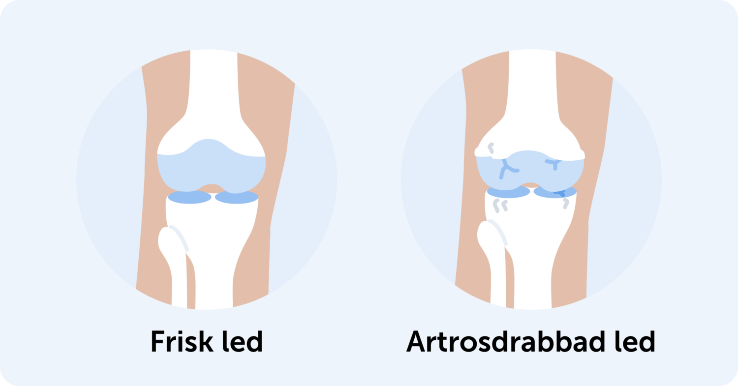 Illustration på en frisk knäled till vänster och en artrosdrabbad knäled till höger.
