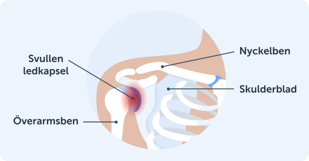 Frozen shoulder orsaker, symtom & behandling Joint Academy