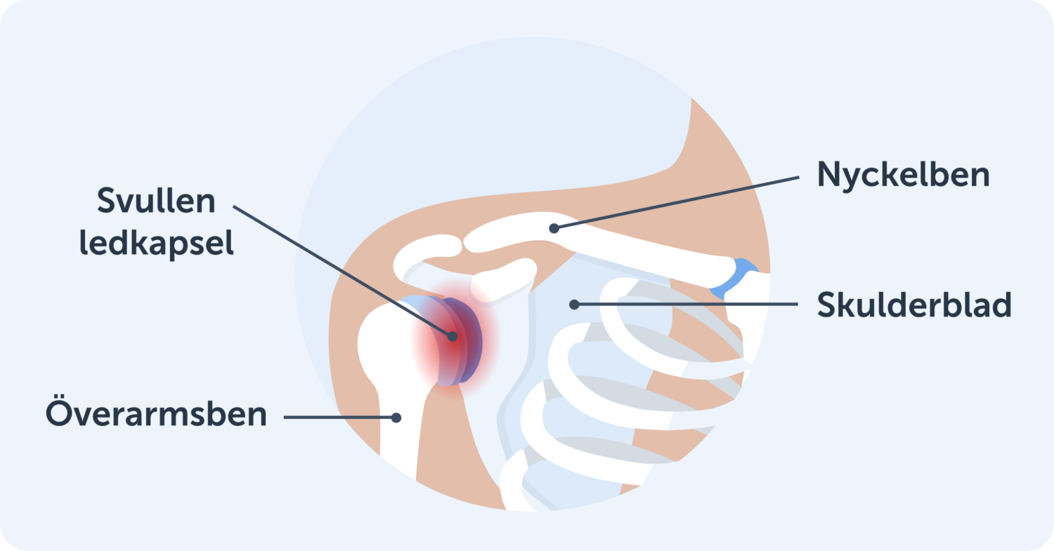 En illustration av axelns anatomi som visar de tre benen som utgör axelleden samt en svullen ledkapsel. 